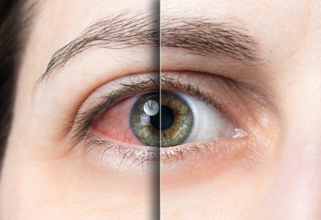 Example of dry eyes before and after treatment for dry eyes syndrome. 